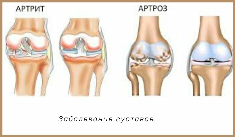 Артрит или артроз? Боль в суставах, лечим сами!