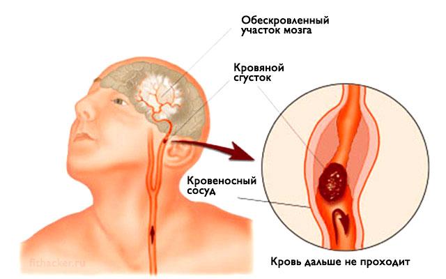 ИНСУЛЬТ: Запомните всего 3 первых шага, чтобы спасти себе и близким жизнь!