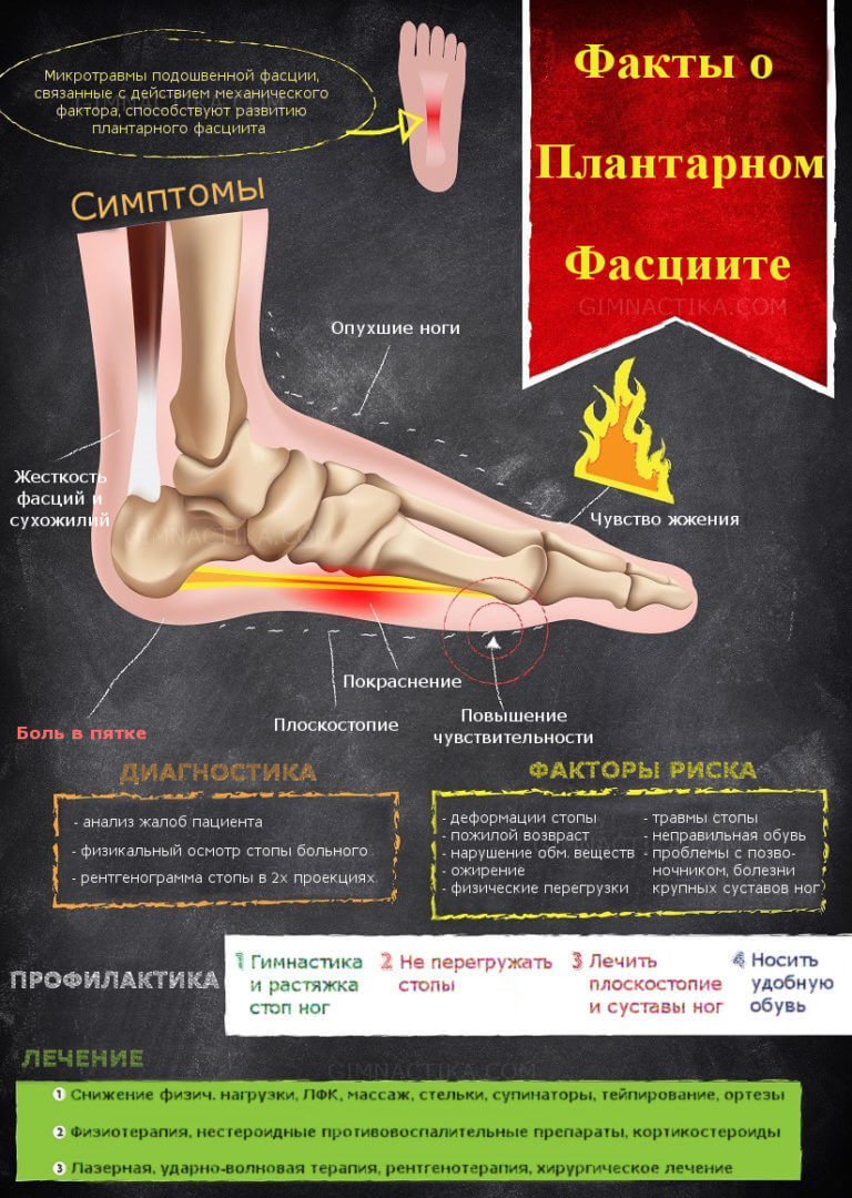 Плантарный фасциит: 13 лучших упражнений при пяточной шпоре 