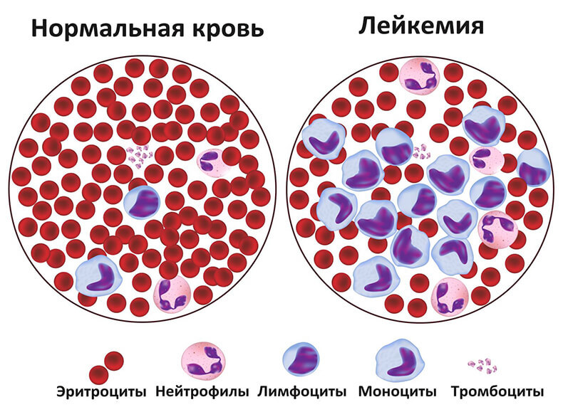 ВАЖНО! 16 признаков лейкемии, о которых необходимо знать