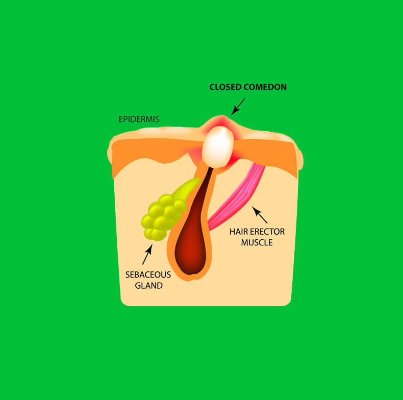 Комедоны: 25 натуральный средств, которые помогут избавиться от угрей